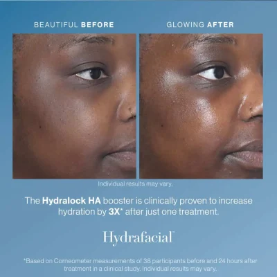 HydraFacial in PINEVILLE 3