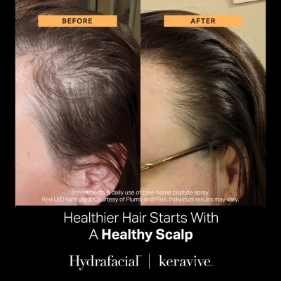 Hydrafacial_Healthy Scalp